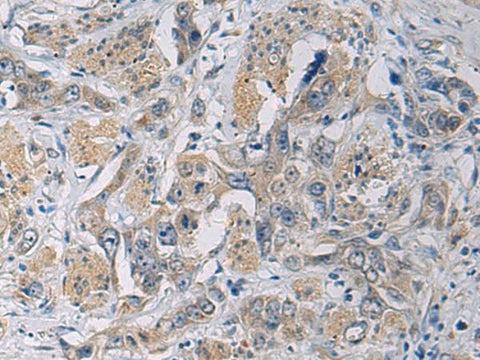 Immunohistochemistry of paraffin-embedded Human esophagus cancer tissue using CYTIP Polyclonal Antibody at dilution of 1:50(×200)