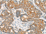 Immunohistochemistry of paraffin-embedded Human liver cancer tissue using CCT8L2 Polyclonal Antibody at dilution of 1:45(×200)