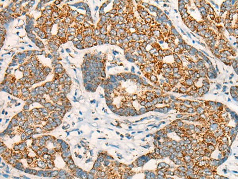 Immunohistochemistry of paraffin-embedded Human liver cancer tissue using CCT8L2 Polyclonal Antibody at dilution of 1:45(×200)