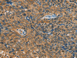 Immunohistochemistry of paraffin-embedded Human cervical cancer tissue using YTHDF1 Polyclonal Antibody at dilution of 1:55(×200)
