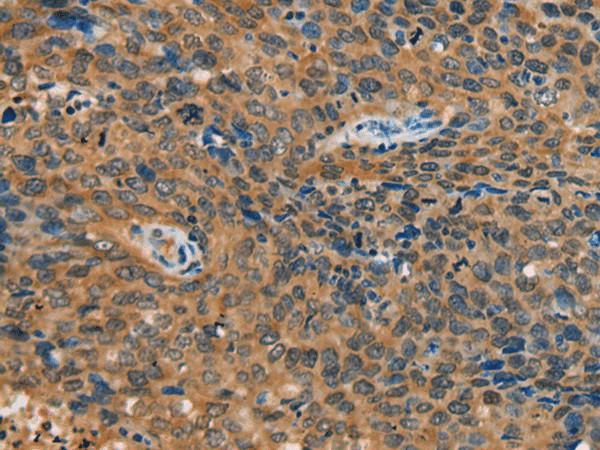 Immunohistochemistry of paraffin-embedded Human cervical cancer tissue using YTHDF1 Polyclonal Antibody at dilution of 1:55(×200)