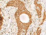Immunohistochemistry of paraffin-embedded Human esophagus cancer tissue using RMND5B Polyclonal Antibody at dilution of 1:50(×200)
