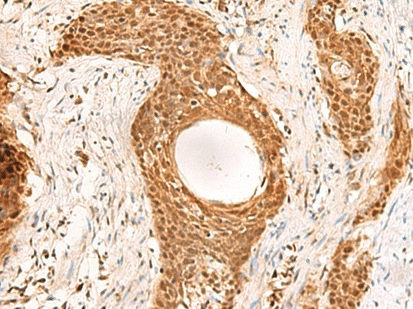 Immunohistochemistry of paraffin-embedded Human esophagus cancer tissue using RMND5B Polyclonal Antibody at dilution of 1:50(×200)