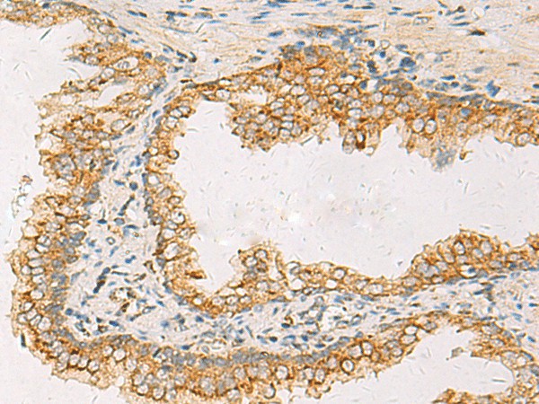 Immunohistochemistry of paraffin-embedded Human prost at e cancer tissue using SUSD3 Polyclonal Antibody at dilution of 1:85(×200)