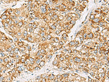 Immunohistochemistry of paraffin-embedded Human liver cancer tissue using ZPBP2 Polyclonal Antibody at dilution of 1:50(×200)
