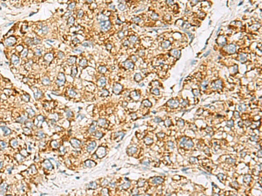 Immunohistochemistry of paraffin-embedded Human liver cancer tissue using ZPBP2 Polyclonal Antibody at dilution of 1:50(×200)