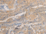 Immunohistochemistry of paraffin-embedded Human thyroid cancer tissue using AGAP3 Polyclonal Antibody at dilution of 1:25(×200)