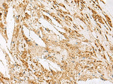 Immunohistochemistry of paraffin-embedded Human thyroid cancer tissue using DNPEP Polyclonal Antibody at dilution of 1:60(×200)