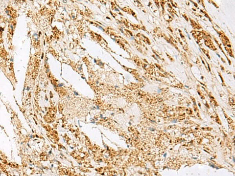 Immunohistochemistry of paraffin-embedded Human thyroid cancer tissue using DNPEP Polyclonal Antibody at dilution of 1:60(×200)