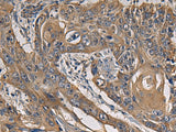 Immunohistochemistry of paraffin-embedded Human esophagus cancer tissue using CCNI Polyclonal Antibody at dilution of 1:65(×200)