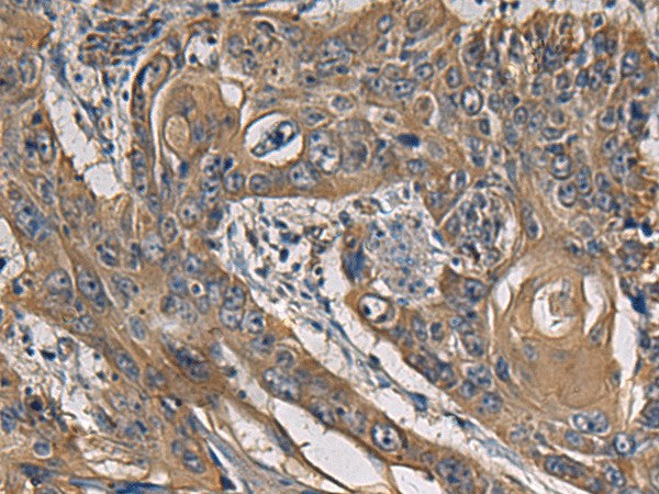 Immunohistochemistry of paraffin-embedded Human esophagus cancer tissue using CCNI Polyclonal Antibody at dilution of 1:65(×200)