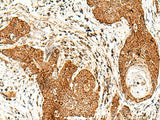 Immunohistochemistry of paraffin-embedded Human esophagus cancer tissue using SMOC1 Polyclonal Antibody at dilution of 1:50(×200)