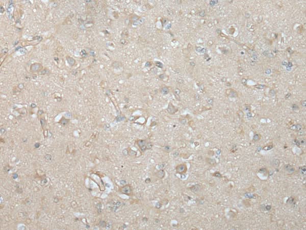 Immunohistochemistry of paraffin-embedded Human brain tissue using VILL Polyclonal Antibody at dilution of 1:65(×200)