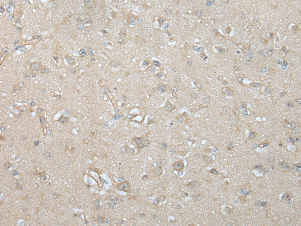 Immunohistochemistry of paraffin-embedded Human brain tissue using VILL Polyclonal Antibody at dilution of 1:65(×200)