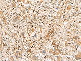 Immunohistochemistry of paraffin-embedded Human liver cancer tissue using PLCB2 Polyclonal Antibody at dilution of 1:60(×200)