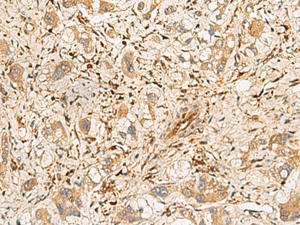 Immunohistochemistry of paraffin-embedded Human liver cancer tissue using PLCB2 Polyclonal Antibody at dilution of 1:60(×200)