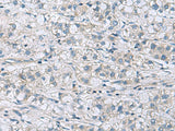 Immunohistochemistry of paraffin-embedded Human liver cancer tissue using ITGB1BP1 Polyclonal Antibody at dilution of 1:60(×200)