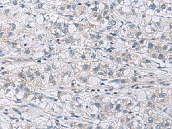 Immunohistochemistry of paraffin-embedded Human liver cancer tissue using ITGB1BP1 Polyclonal Antibody at dilution of 1:60(×200)