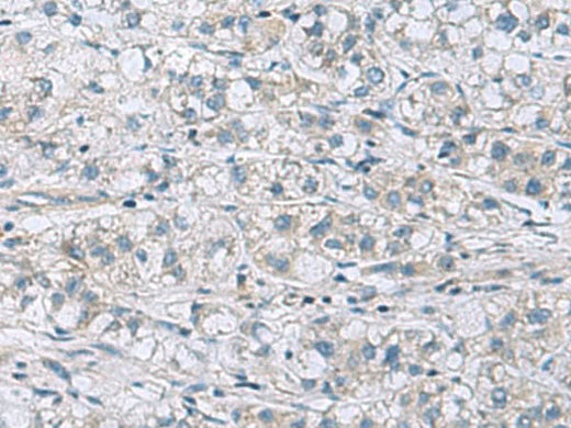Immunohistochemistry of paraffin-embedded Human liver cancer tissue using ITGB1BP1 Polyclonal Antibody at dilution of 1:60(×200)