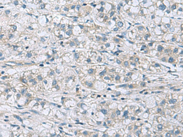 Immunohistochemistry of paraffin-embedded Human liver cancer tissue using ITGB1BP1 Polyclonal Antibody at dilution of 1:60(×200)