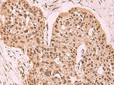 Immunohistochemistry of paraffin-embedded Human esophagus cancer tissue using SETDB1 Polyclonal Antibody at dilution of 1:60(×200)
