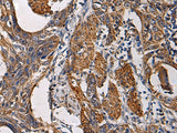 Immunohistochemistry of paraffin-embedded Human esophagus cancer tissue using SSH3 Polyclonal Antibody at dilution of 1:60(×200)