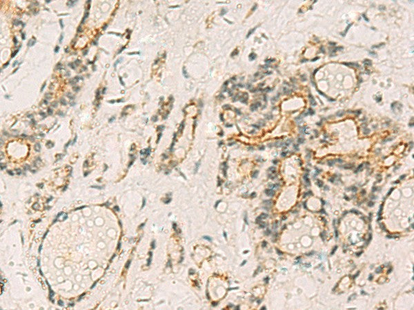 Immunohistochemistry of paraffin-embedded Human thyroid cancer tissue using HORMAD2 Polyclonal Antibody at dilution of 1:35(×200)