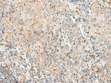 Immunohistochemistry of paraffin-embedded Human cervical cancer tissue using EIF3L Polyclonal Antibody at dilution of 1:55(×200)