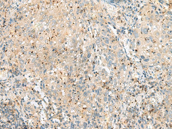 Immunohistochemistry of paraffin-embedded Human cervical cancer tissue using EIF3L Polyclonal Antibody at dilution of 1:55(×200)