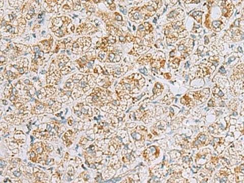 Immunohistochemistry of paraffin-embedded Human liver cancer tissue using INS(C-peptide) Polyclonal Antibody at dilution of 1:40(×200)