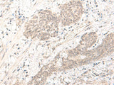 Immunohistochemistry of paraffin-embedded Human esophagus cancer tissue using PBXIP1 Polyclonal Antibody at dilution of 1:40(×200)