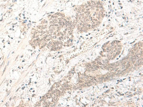 Immunohistochemistry of paraffin-embedded Human esophagus cancer tissue using PBXIP1 Polyclonal Antibody at dilution of 1:40(×200)