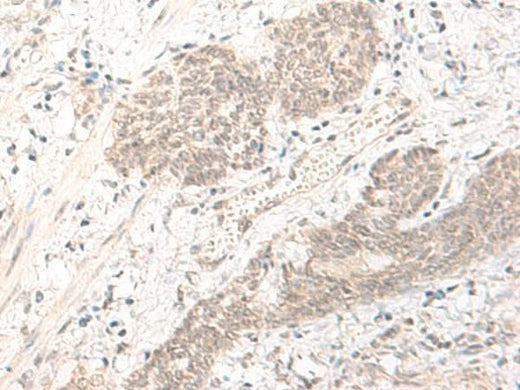 Immunohistochemistry of paraffin-embedded Human esophagus cancer tissue using PBXIP1 Polyclonal Antibody at dilution of 1:40(×200)