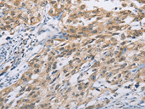 Immunohistochemistry of paraffin-embedded Human esophagus cancer tissue using ZIC5 Polyclonal Antibody at dilution of 1:100(×200)