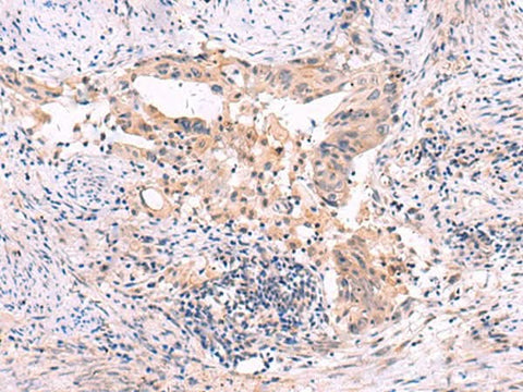 Immunohistochemistry of paraffin-embedded Human cervical cancer tissue using SLC12A5 Polyclonal Antibody at dilution of 1:40(×200)