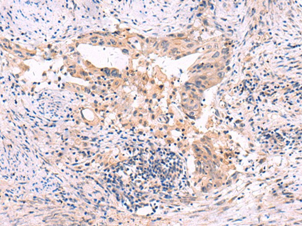 Immunohistochemistry of paraffin-embedded Human cervical cancer tissue using SLC12A5 Polyclonal Antibody at dilution of 1:40(×200)