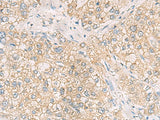 Immunohistochemistry of paraffin-embedded Human liver cancer tissue using MAPK14 Polyclonal Antibody at dilution of 1:70(×200)