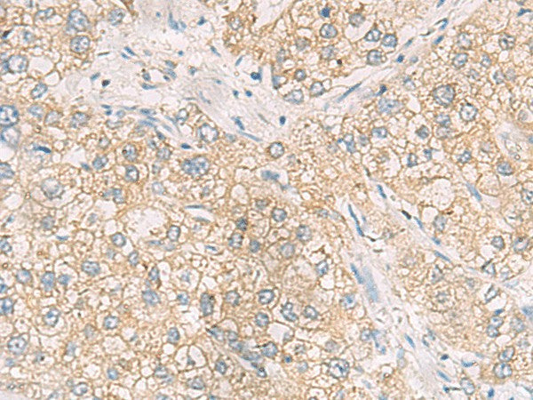 Immunohistochemistry of paraffin-embedded Human liver cancer tissue using MAPK14 Polyclonal Antibody at dilution of 1:70(×200)