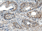 Immunohistochemistry of paraffin-embedded Human cervical cancer tissue using PRNP Polyclonal Antibody at dilution of 1:45(×200)