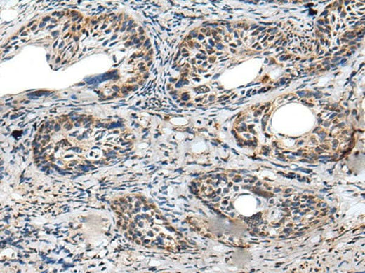 Immunohistochemistry of paraffin-embedded Human cervical cancer tissue using PRNP Polyclonal Antibody at dilution of 1:45(×200)
