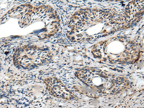 Immunohistochemistry of paraffin-embedded Human cervical cancer tissue using PRNP Polyclonal Antibody at dilution of 1:45(×200)