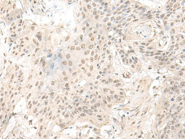 Immunohistochemistry of paraffin-embedded Human esophagus cancer tissue using ILKAP Polyclonal Antibody at dilution of 1:50(×200)