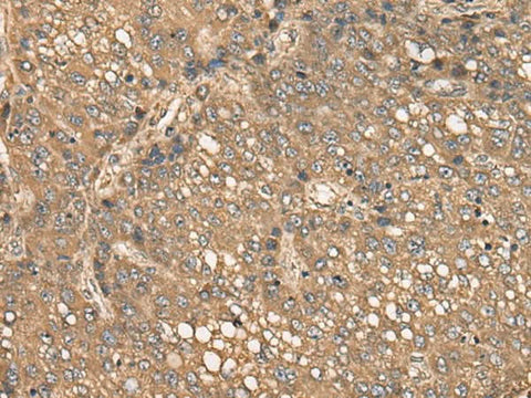 Immunohistochemistry of paraffin-embedded Human liver cancer tissue using C4BPB Polyclonal Antibody at dilution of 1:35(×200)