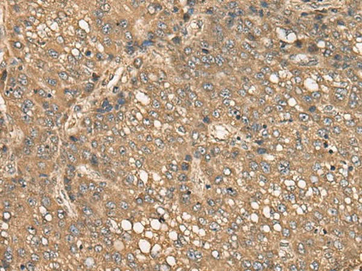 Immunohistochemistry of paraffin-embedded Human liver cancer tissue using C4BPB Polyclonal Antibody at dilution of 1:35(×200)