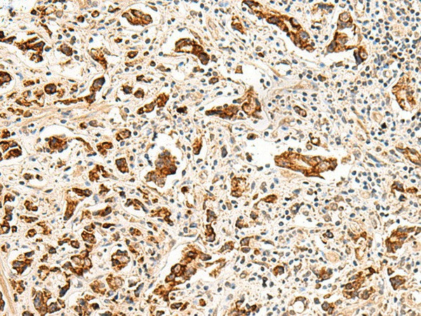 Immunohistochemistry of paraffin-embedded Human prost at e cancer tissue using GPR160 Polyclonal Antibody at dilution of 1:35(×200)