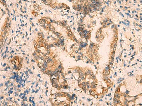Immunohistochemistry of paraffin-embedded Human cervical cancer tissue using CRYM Polyclonal Antibody at dilution of 1:65(×200)