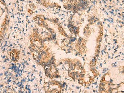 Immunohistochemistry of paraffin-embedded Human cervical cancer tissue using CRYM Polyclonal Antibody at dilution of 1:65(×200)