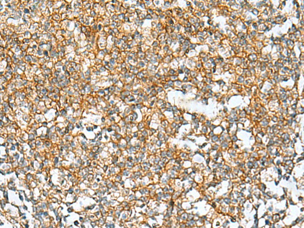 Immunohistochemistry of paraffin-embedded Human tonsil tissue using RAB13 Polyclonal Antibody at dilution of 1:50(×200)