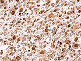 Immunohistochemistry of paraffin-embedded Human gastric cancer tissue using INO80 Polyclonal Antibody at dilution of 1:85(×200)