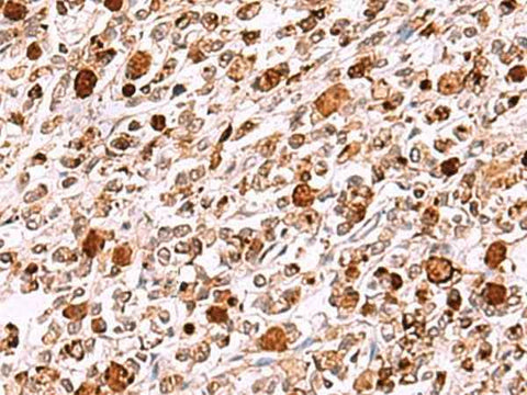 Immunohistochemistry of paraffin-embedded Human gastric cancer tissue using INO80 Polyclonal Antibody at dilution of 1:85(×200)